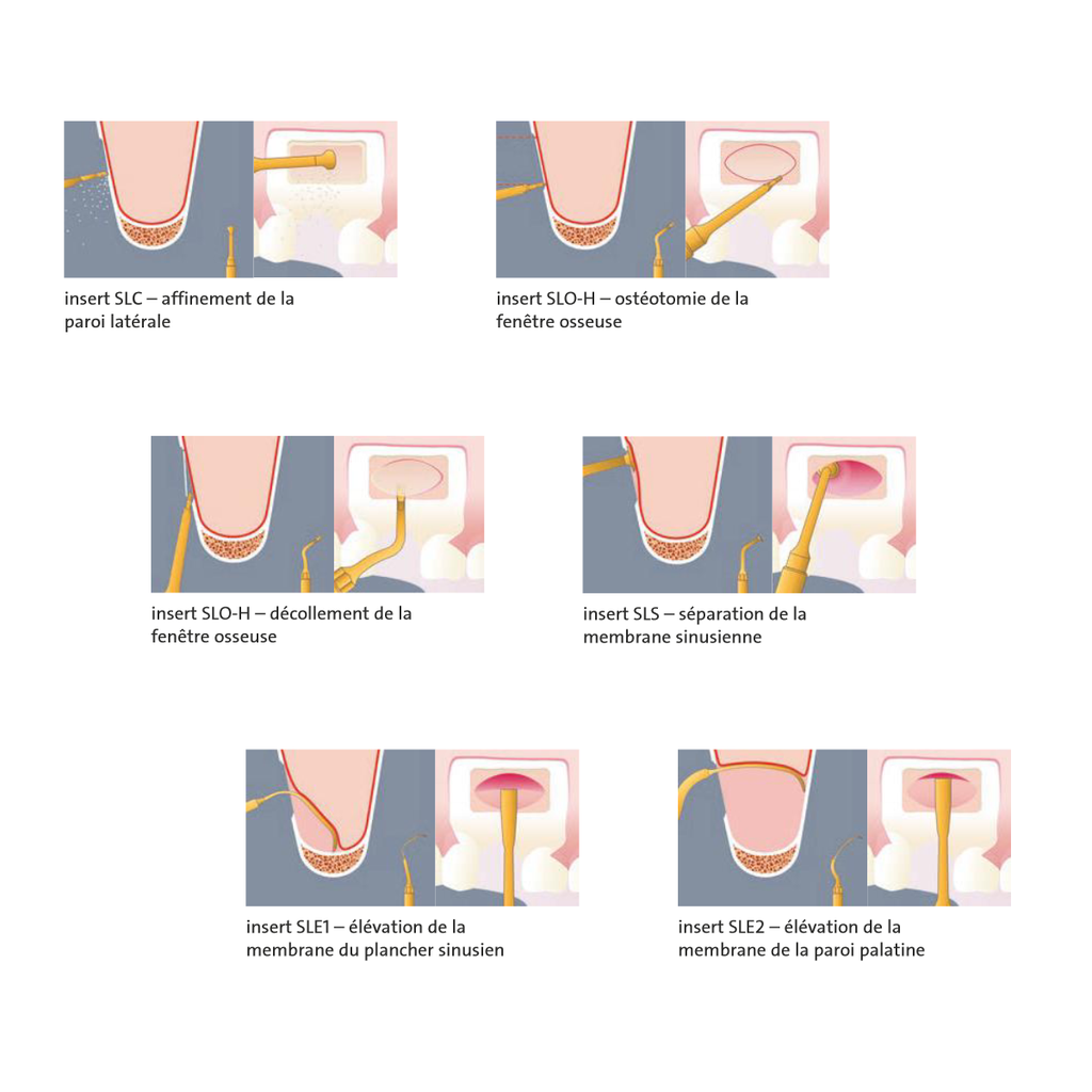 SET SINUS LIFT LATERAL Mectron