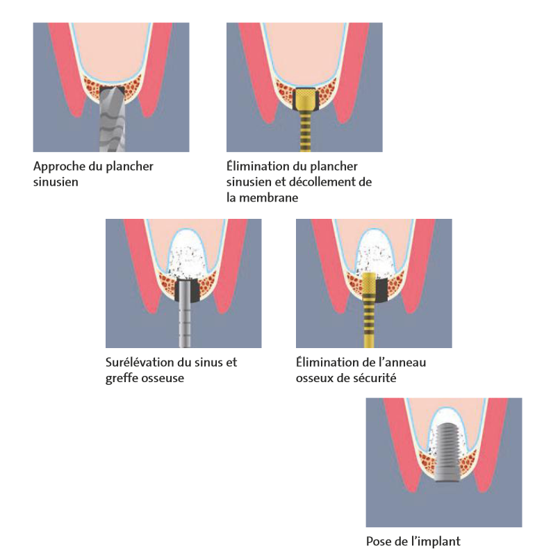 SET MANUAL PIEZO LIFT