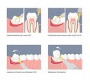 SET THIRD MOLAR EXTRACTION Mectron